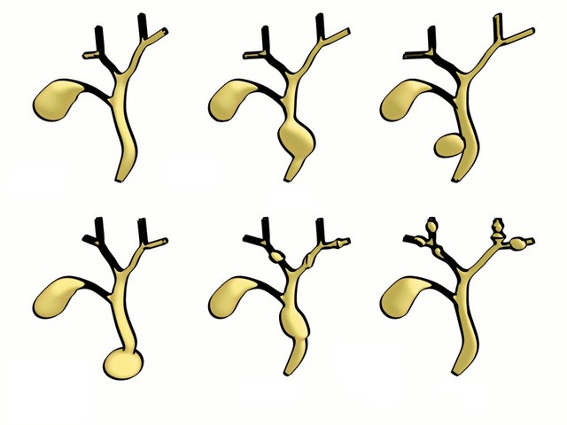 Hẹp đường mật bẩm sinh - Hình ảnh minh họa